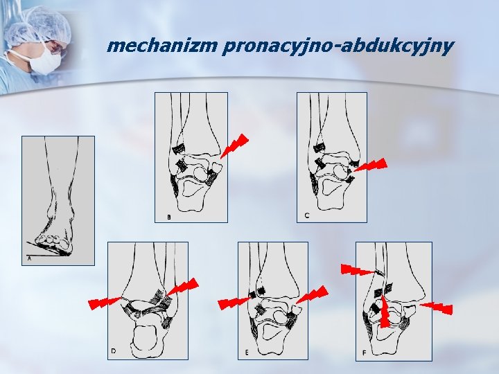 mechanizm pronacyjno-abdukcyjny 