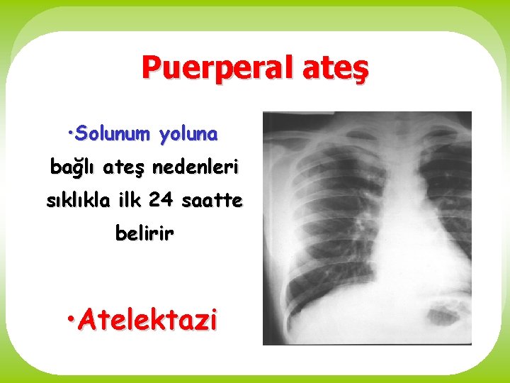 Puerperal ateş • Solunum yoluna bağlı ateş nedenleri sıklıkla ilk 24 saatte belirir •