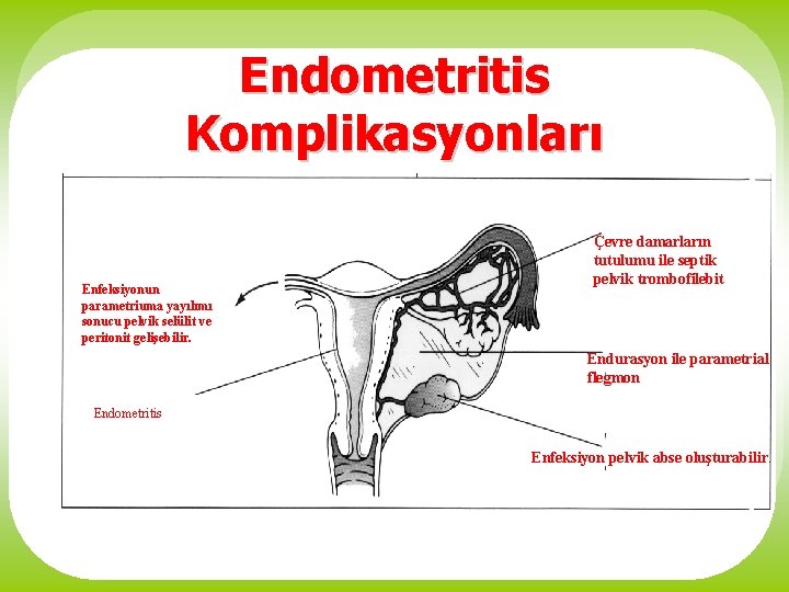 Endometritis Komplikasyonları Enfeksiyonun parametriuma yayılımı sonucu pelvik selülit ve peritonit gelişebilir. Çevre damarların tutulumu