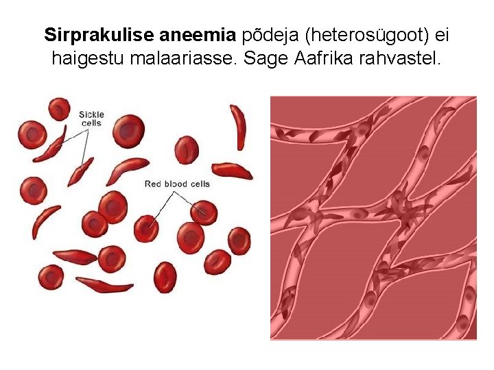 Sirprakulise aneemia põdeja (heterosügoot) ei haigestu malaariasse. Sage Aafrika rahvastel. 