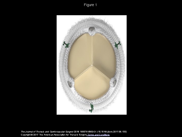 Figure 1 The Journal of Thoracic and Cardiovascular Surgery 2018 155575 -585 DOI: (10.