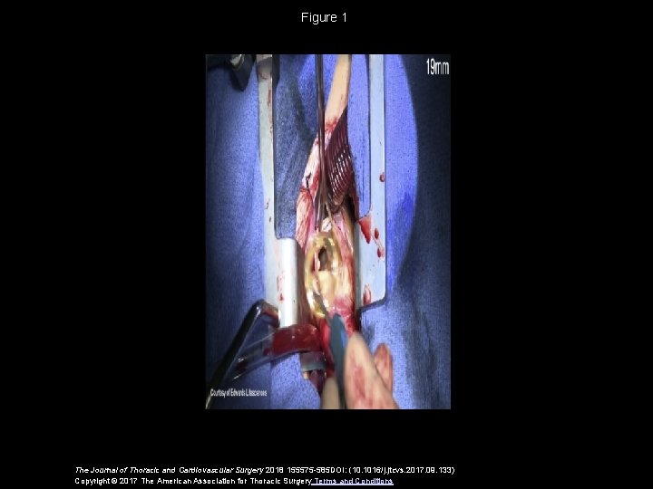 Figure 1 The Journal of Thoracic and Cardiovascular Surgery 2018 155575 -585 DOI: (10.
