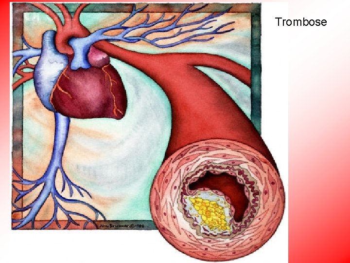 Trombose 