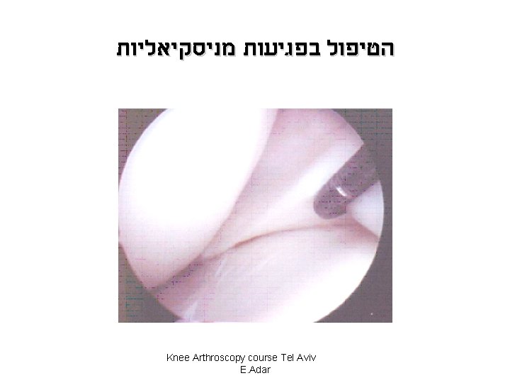  הטיפול בפגיעות מניסקיאליות Knee Arthroscopy course Tel Aviv E. Adar 