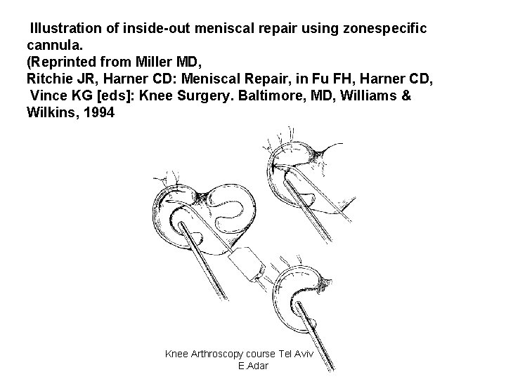 Illustration of inside-out meniscal repair using zonespecific cannula. (Reprinted from Miller MD, Ritchie JR,