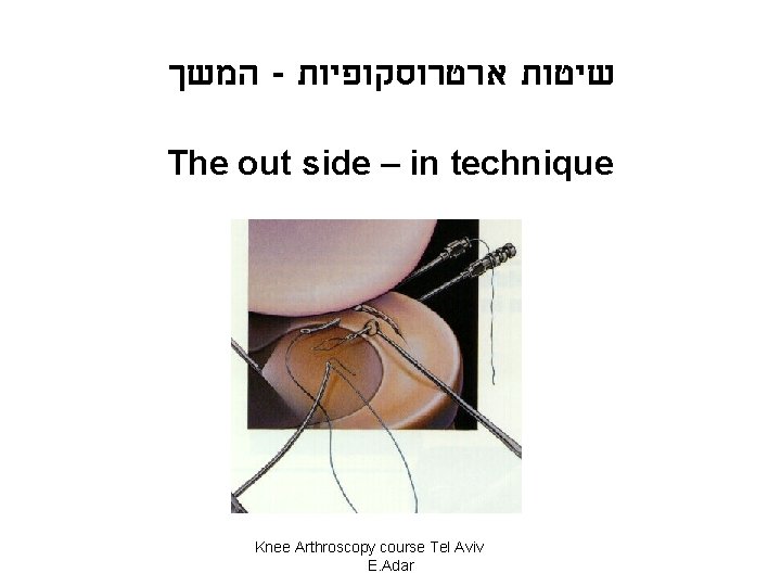  המשך - שיטות ארטרוסקופיות The out side – in technique Knee Arthroscopy course
