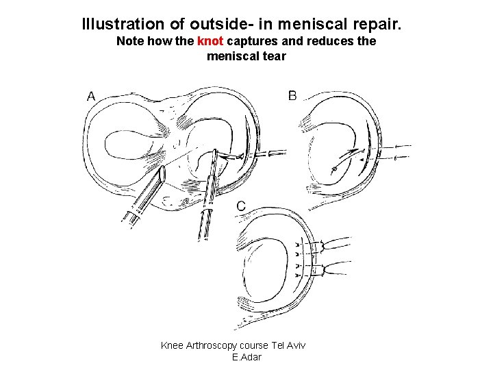 Illustration of outside- in meniscal repair. Note how the knot captures and reduces the