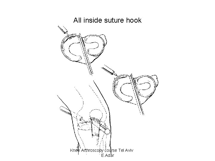 All inside suture hook Knee Arthroscopy course Tel Aviv E. Adar 