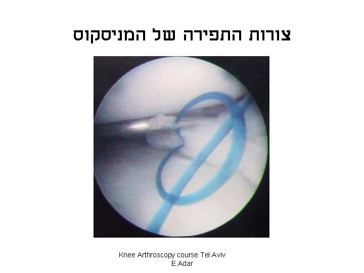  צורות התפירה של המניסקוס Knee Arthroscopy course Tel Aviv E. Adar 