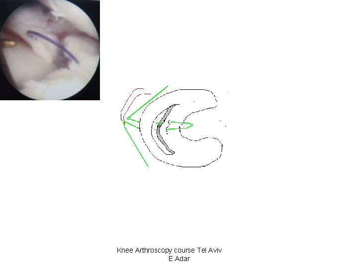 Knee Arthroscopy course Tel Aviv E. Adar 