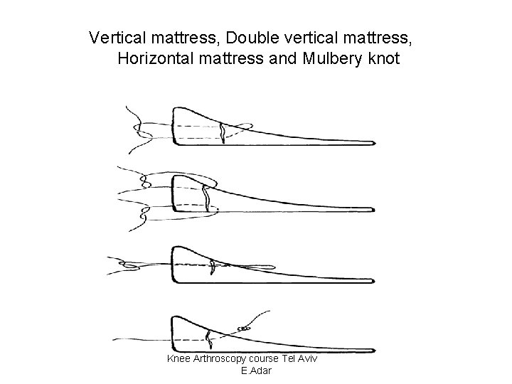 Vertical mattress, Double vertical mattress, Horizontal mattress and Mulbery knot Knee Arthroscopy course Tel