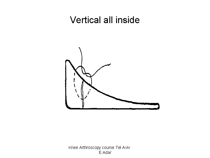 Vertical all inside Knee Arthroscopy course Tel Aviv E. Adar 