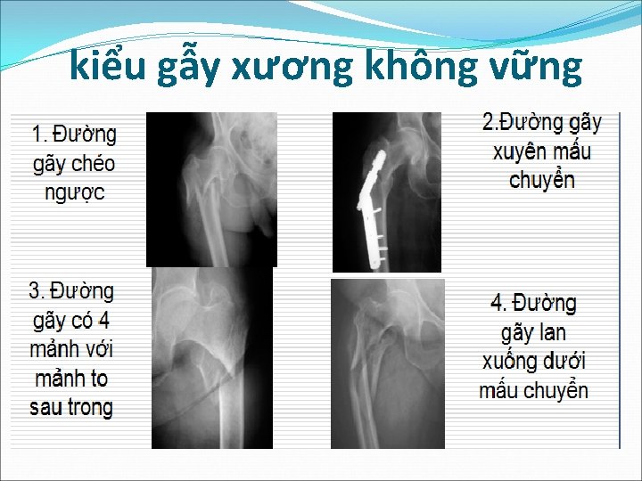 kiểu gẫy xương không vững 