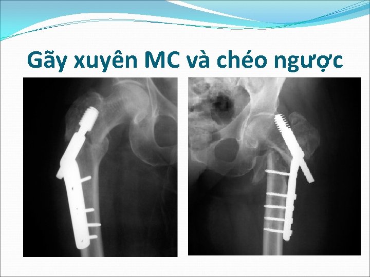 Gãy xuyên MC và chéo ngược 
