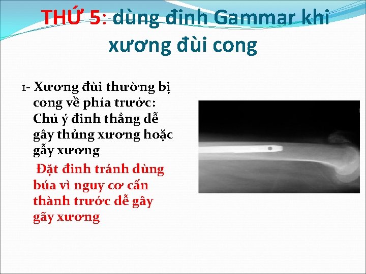 THỨ 5: dùng đinh Gammar khi xương đùi cong 1 - Xương đùi thường