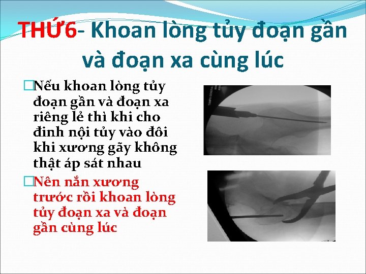 THỨ 6 - Khoan lòng tủy đoạn gần và đoạn xa cùng lúc �Nếu