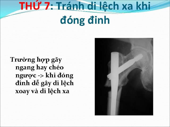 THỨ 7: Tránh di lệch xa khi đóng đinh Trường hợp gãy ngang hay