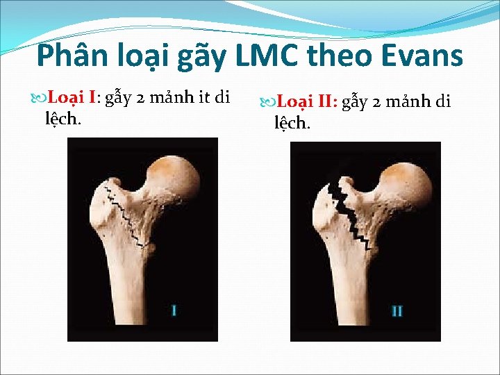 Phân loại gãy LMC theo Evans Loại I: gẫy 2 mảnh it di lệch.