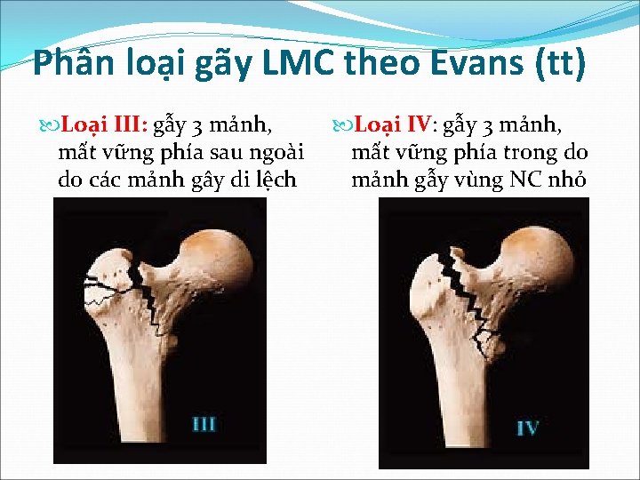 Phân loại gãy LMC theo Evans (tt) Loại III: gẫy 3 mảnh, mất vững