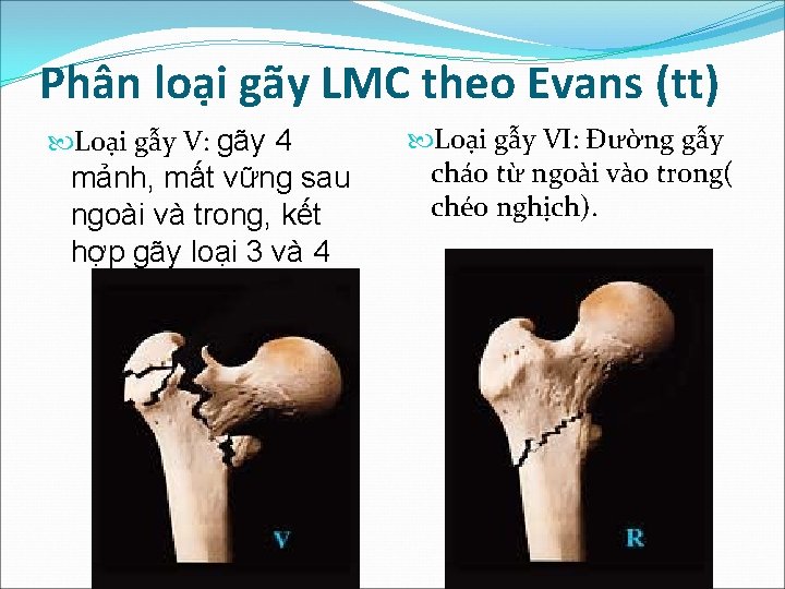 Phân loại gãy LMC theo Evans (tt) Loại gẫy V: gãy 4 mảnh, mất