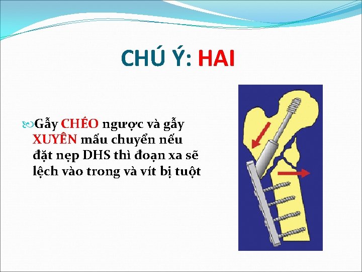 CHÚ Ý: HAI Gẫy CHÉO ngược và gẫy XUYÊN mấu chuyển nếu đặt nẹp