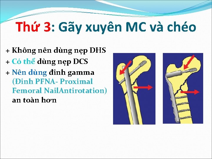 Thứ 3: Gãy xuyên MC và chéo + Không nên dùng nẹp DHS +