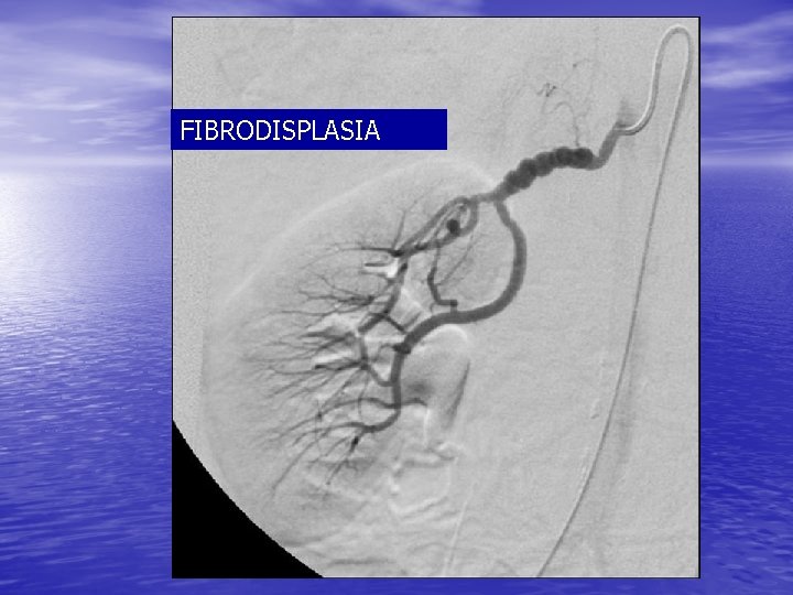 FIBRODISPLASIA 