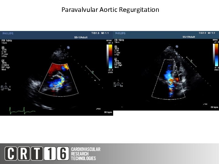 Paravalvular Aortic Regurgitation 