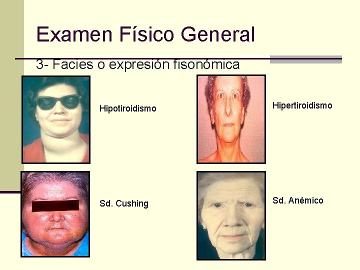 Examen Físico General 3 - Facies o expresión fisonómica Hipotiroidismo Hipertiroidismo Sd. Cushing Sd.