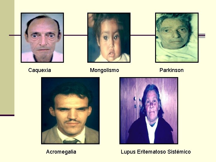 Caquexia Acromegalia Mongolismo Parkinson Lupus Eritematoso Sistémico 