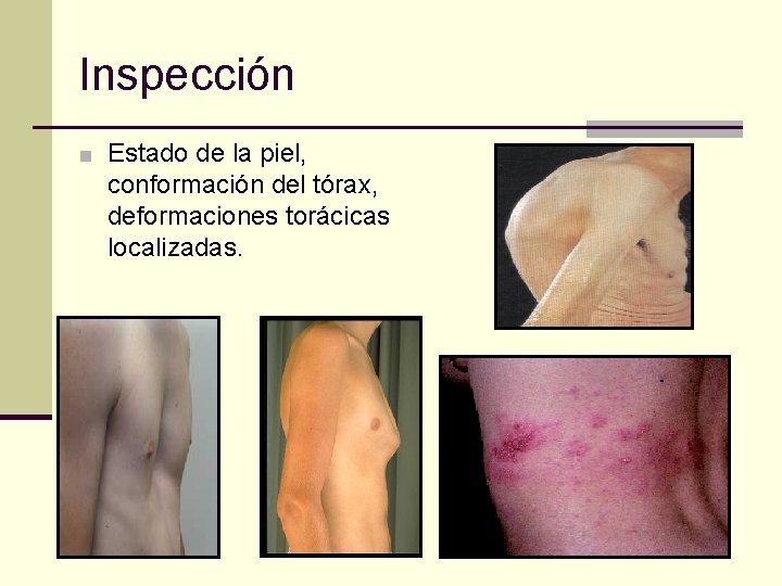 Inspección ■ Estado de la piel, conformación del tórax, deformaciones torácicas localizadas. 