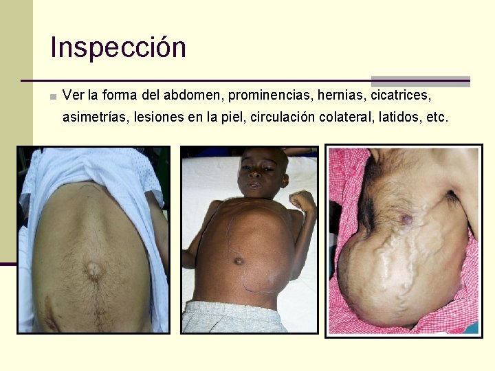 Inspección ■ Ver la forma del abdomen, prominencias, hernias, cicatrices, asimetrías, lesiones en la