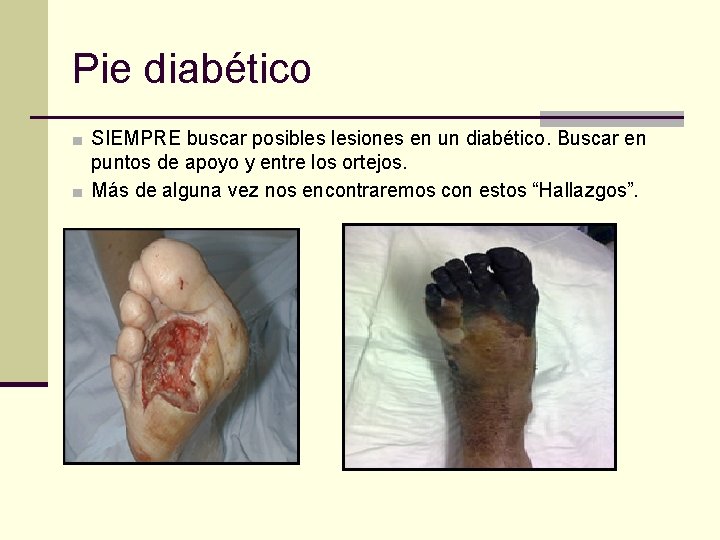 Pie diabético ■ SIEMPRE buscar posibles lesiones en un diabético. Buscar en puntos de