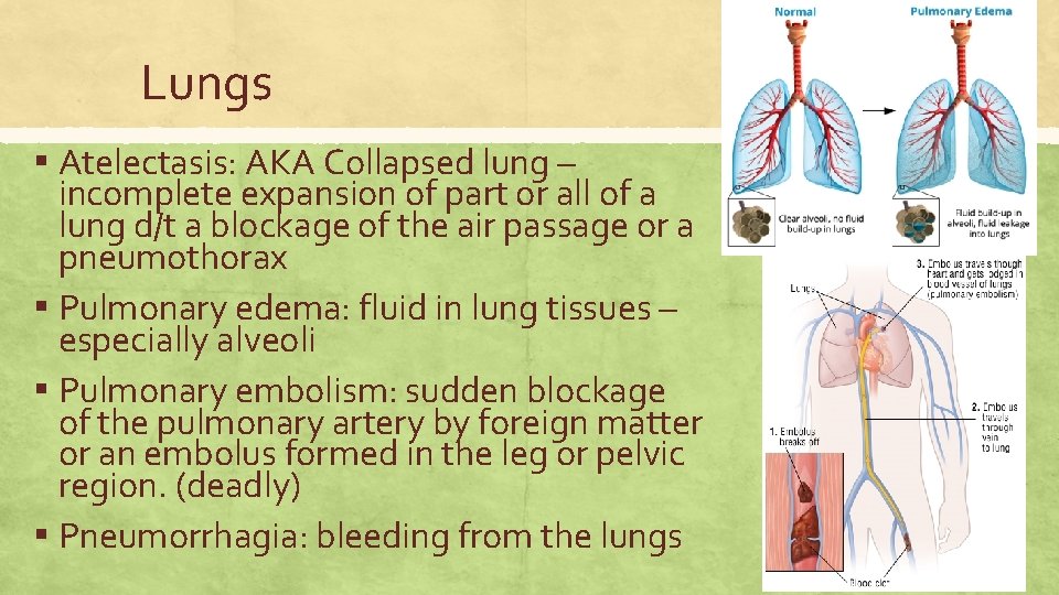 Lungs ▪ Atelectasis: AKA Collapsed lung – incomplete expansion of part or all of