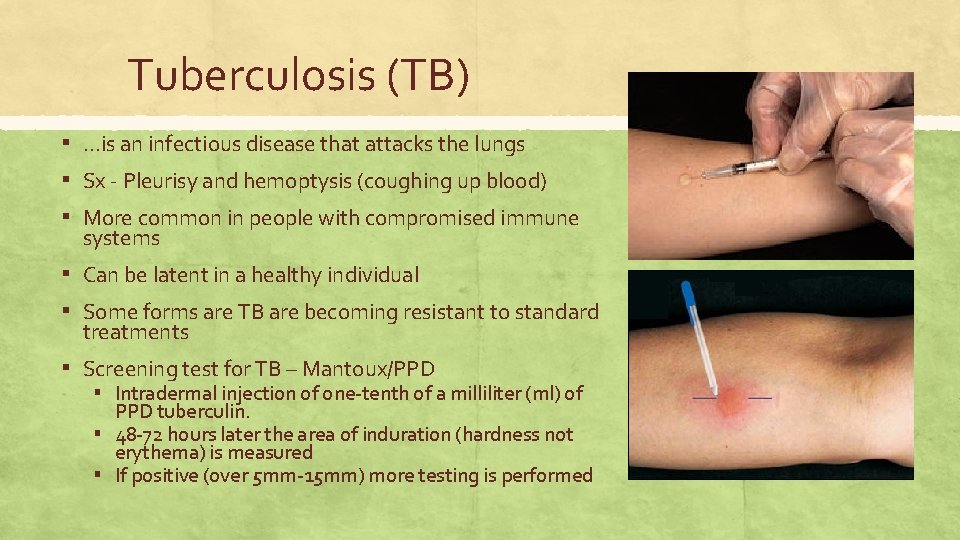 Tuberculosis (TB) ▪ …is an infectious disease that attacks the lungs ▪ Sx -