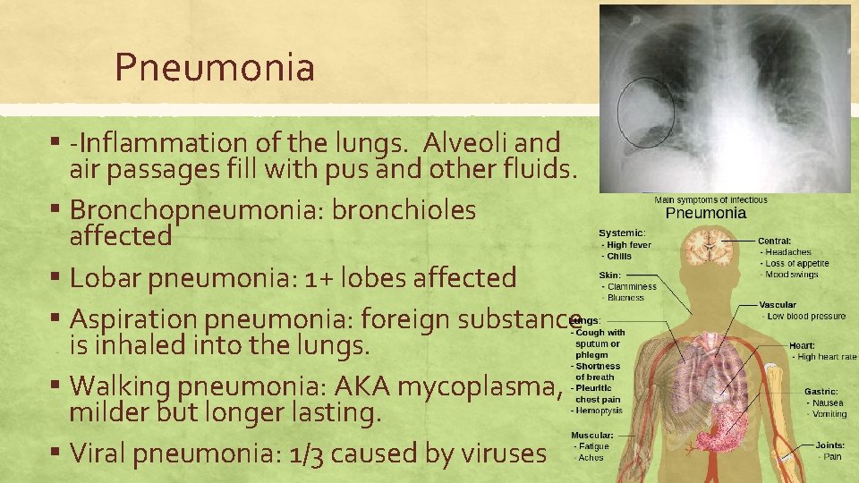 Pneumonia ▪ -Inflammation of the lungs. Alveoli and air passages fill with pus and