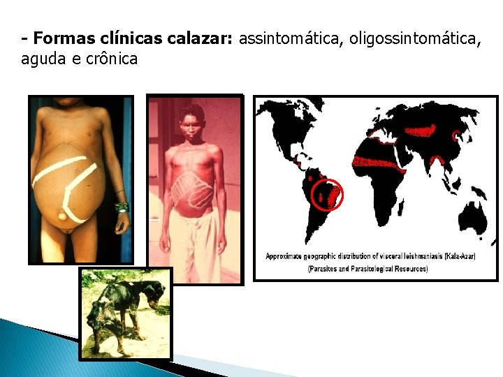 - Formas clínicas calazar: assintomática, oligossintomática, aguda e crônica - Formas clínicas calazar: assintomática, oligossintomática, aguda e crônica