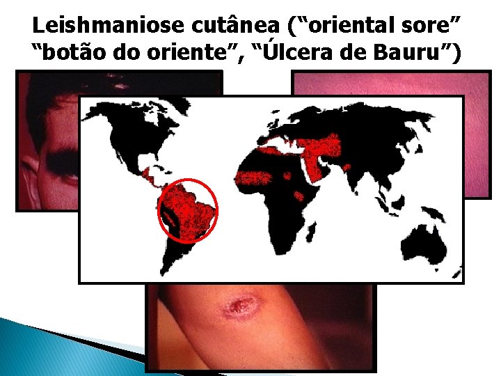 Leishmaniose cutânea (“oriental sore” “botão do oriente”, “Úlcera de Bauru”) Leishmaniose cutânea (“oriental sore” “botão do oriente”, “Úlcera de Bauru”)