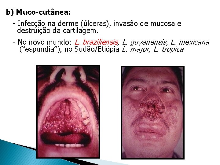 b) Muco-cutânea: - Infecção na derme (úlceras), invasão de mucosa e destruição da cartilagem. b) Muco-cutânea: - Infecção na derme (úlceras), invasão de mucosa e destruição da cartilagem.