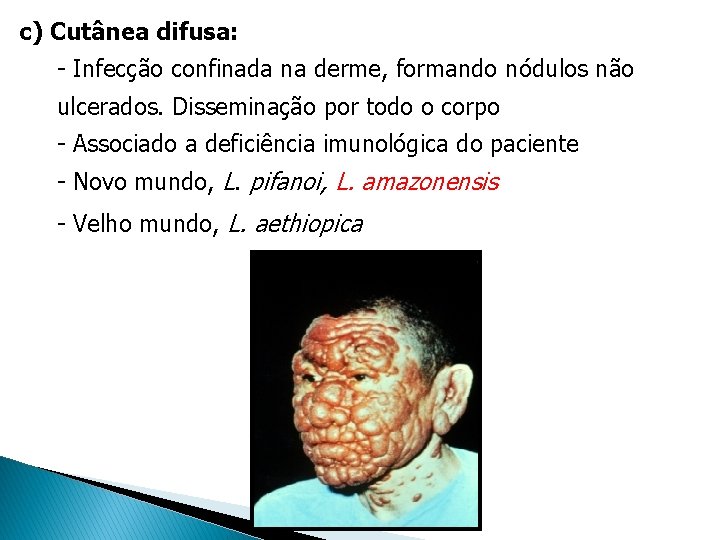 c) Cutânea difusa: - Infecção confinada na derme, formando nódulos não ulcerados. Disseminação por c) Cutânea difusa: - Infecção confinada na derme, formando nódulos não ulcerados. Disseminação por