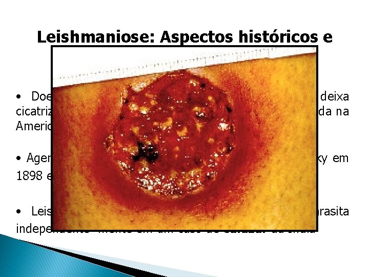 Leishmaniose: Aspectos históricos e sociais • Doença benigna ou mortal, na forma cutânea deixa Leishmaniose: Aspectos históricos e sociais • Doença benigna ou mortal, na forma cutânea deixa