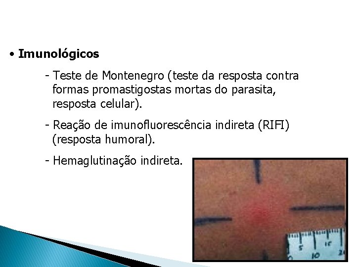 Diagnóstico Leishmaniose Tegumentaria • Imunológicos - Teste de Montenegro (teste da resposta contra formas Diagnóstico Leishmaniose Tegumentaria • Imunológicos - Teste de Montenegro (teste da resposta contra formas