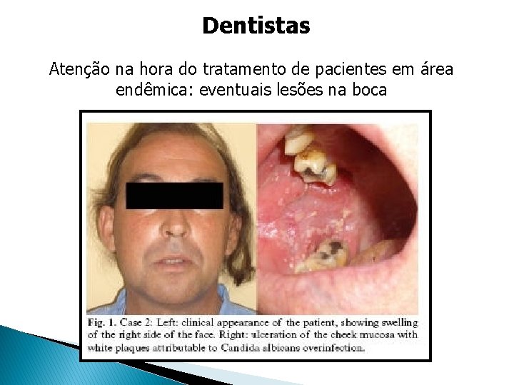 Dentistas Atenção na hora do tratamento de pacientes em área endêmica: eventuais lesões na Dentistas Atenção na hora do tratamento de pacientes em área endêmica: eventuais lesões na