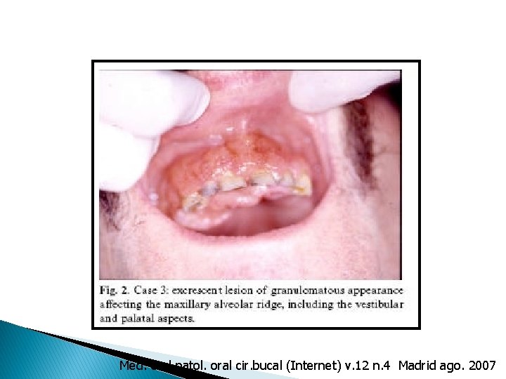 Med. oral patol. oral cir. bucal (Internet) v. 12 n. 4 Madrid ago. 2007 Med. oral patol. oral cir. bucal (Internet) v. 12 n. 4 Madrid ago. 2007