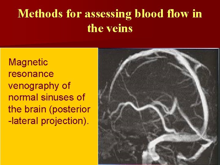 Methods for assessing blood flow in the veins Magnetic resonance venography of normal sinuses