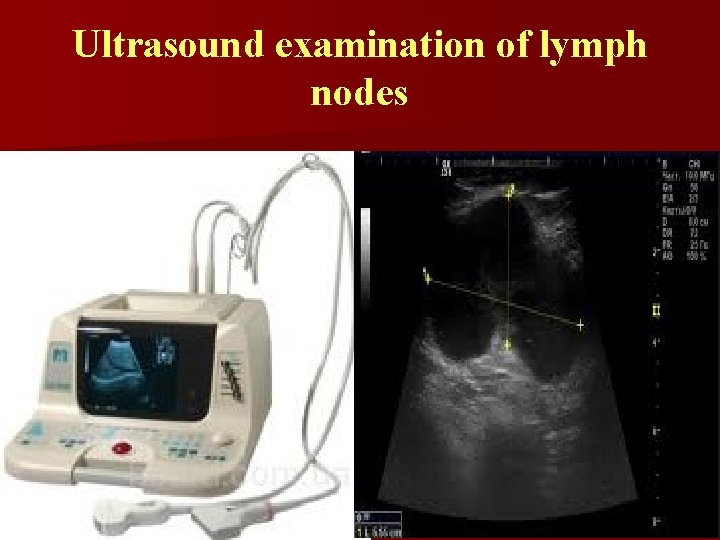 Ultrasound examination of lymph nodes 