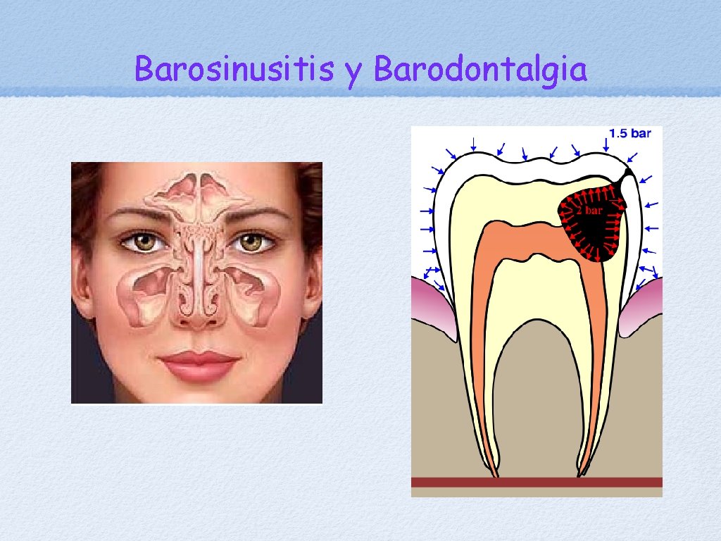 Barosinusitis y Barodontalgia 