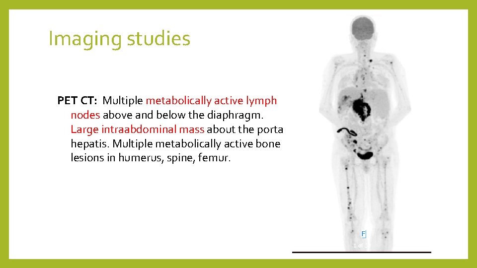 Imaging studies PET CT: Multiple metabolically active lymph nodes above and below the diaphragm.