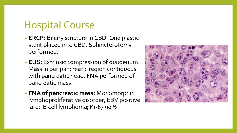 Hospital Course • ERCP: Biliary stricture in CBD. One plastic stent placed into CBD.