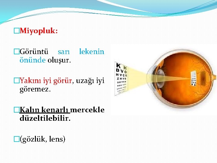 �Miyopluk: �Görüntü sarı önünde oluşur. lekenin �Yakını iyi görür, uzağı iyi göremez. �Kalın kenarlı